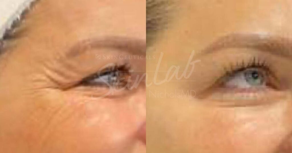 SkinLab Botox Eyes Treatment