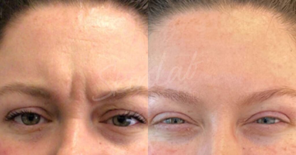 SkinLab Botox Upperface Treatment