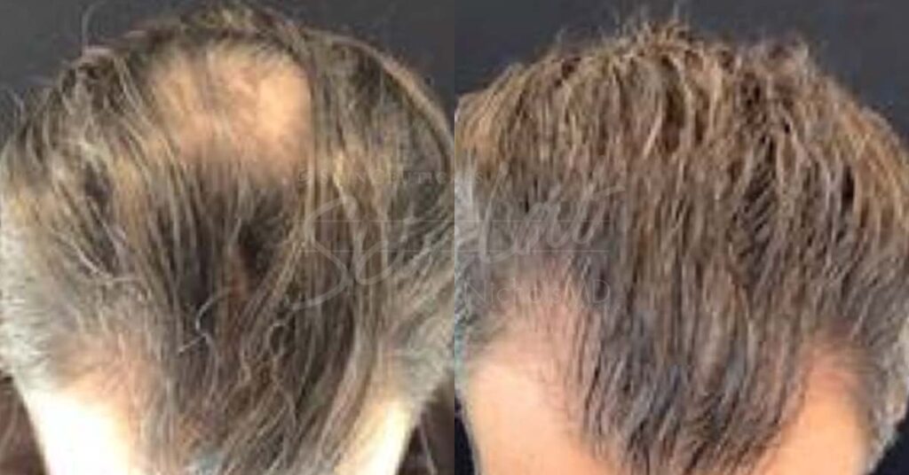 SkinLab PRP Hair Treatment