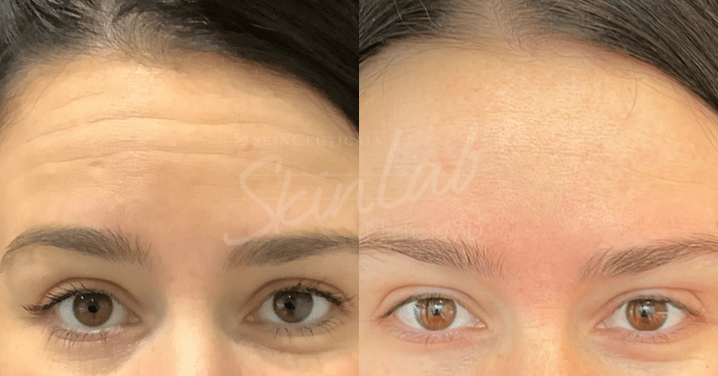 SkinLab Botox Treatment