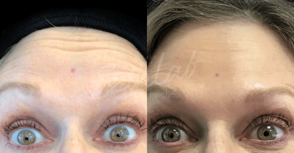 SkinLab Botox Treatment