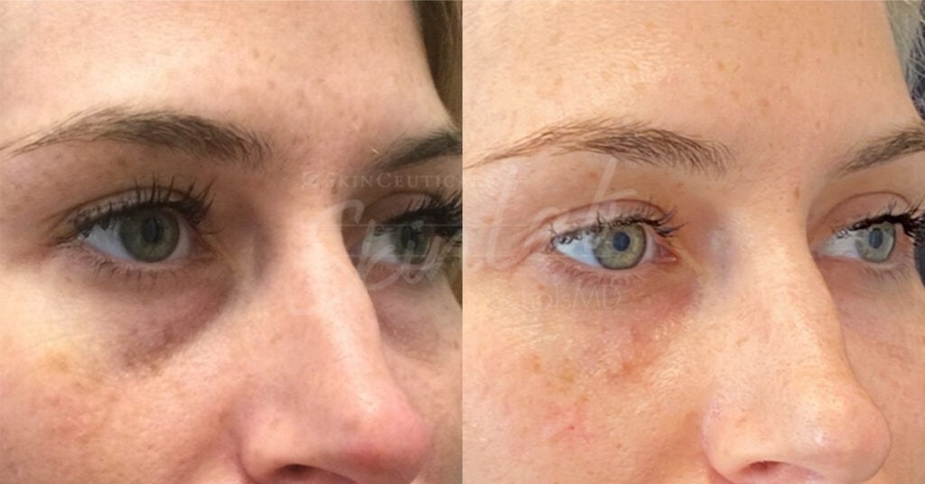 SkinLab Undereye Rejuvenation Treatment