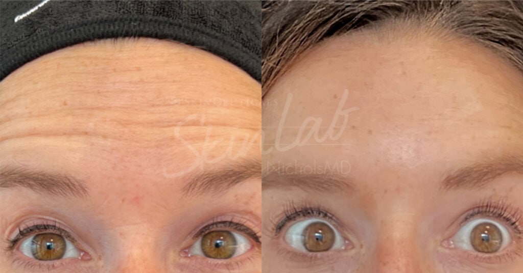 SkinLab Undereye Rejuvenation Treatment