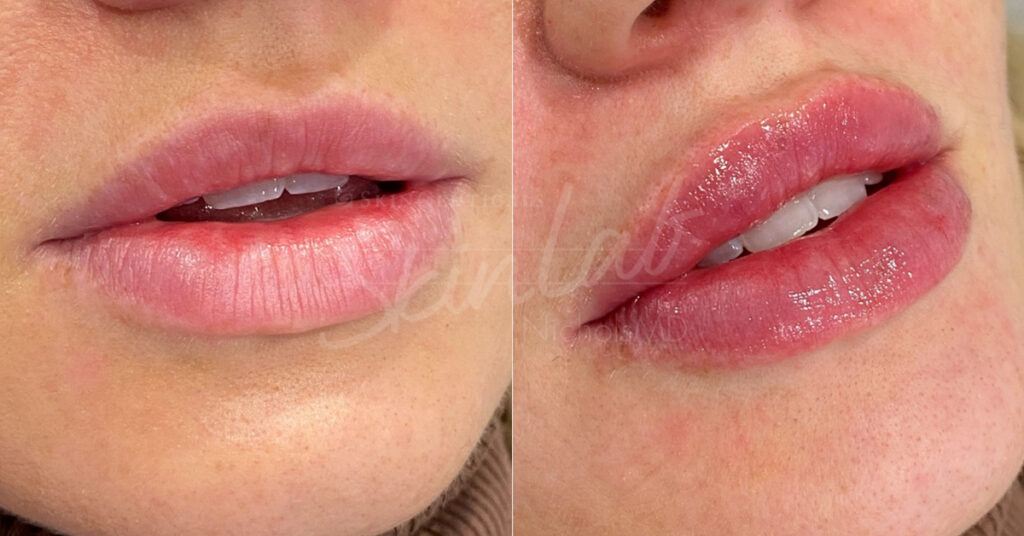 SkinLab Liquid Lip Lift Treatment