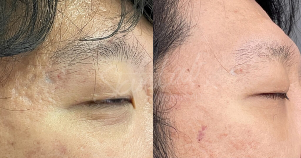 SkinLab Fraxel Laser for Acne Scars Treatment