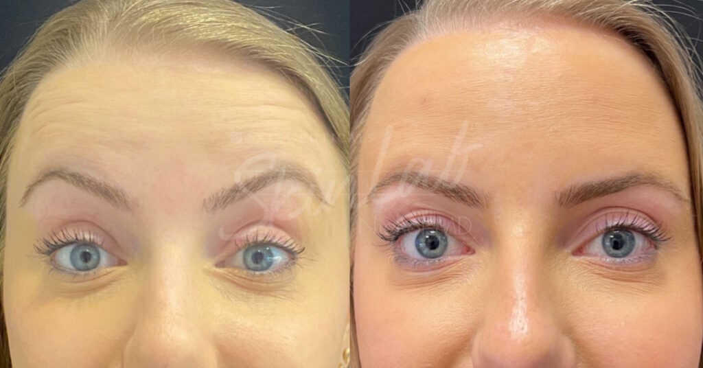 SkinLab Botox Forehead Treatment