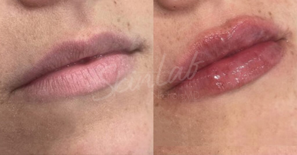 SkinLab Liquid Lip Lift Treatment