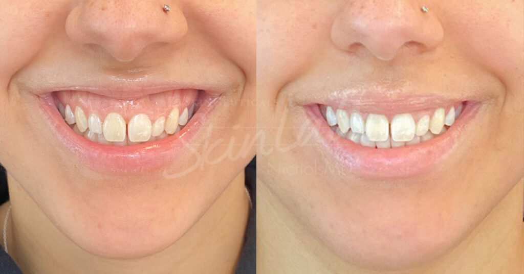 Skinlab Botox(R) for Gummy Smile and Lip Flip Treatment