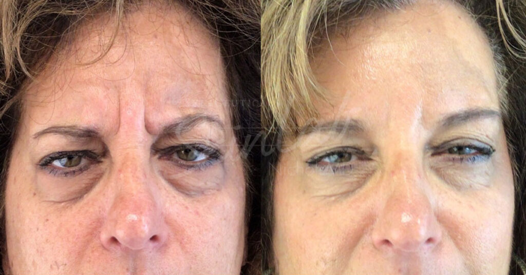 Skinlab Botox® Treatment