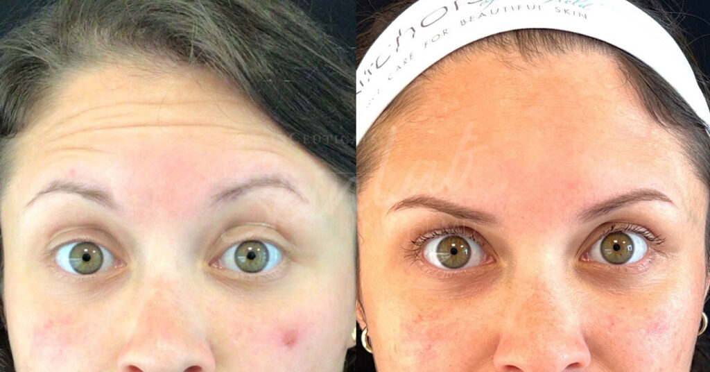 Skinlab Dyspot Forehead Treatment