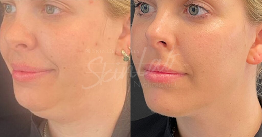 Skinlab Under-Chin Fat Reduction With Kybella Treatment