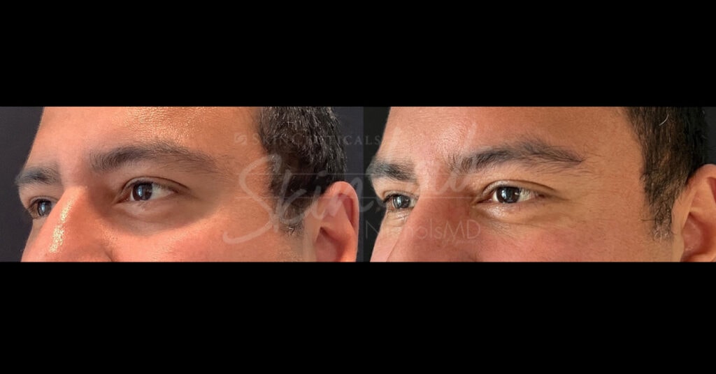 Skinlab Under-eye Filler Treatment