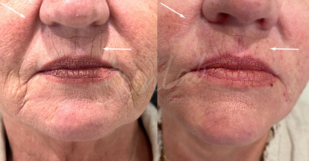 Skinlab Lip-Line Softener with Radiesse® Treatment