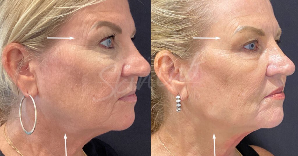 Skinlab Full Face Rejuvenation with PRF Treatment