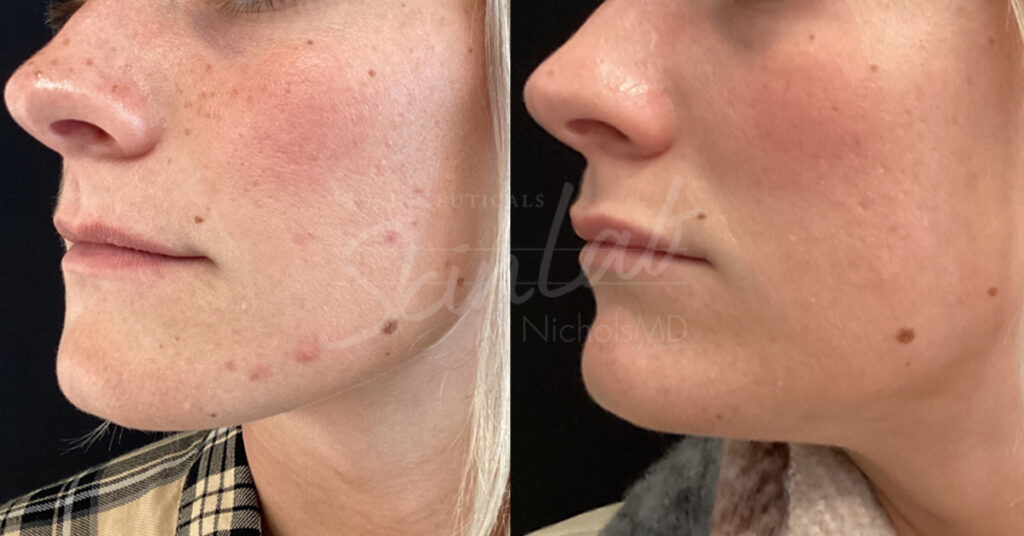 Skinlab AviClear Treatment