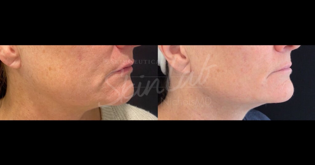SkinLab Jawline with Volux™ Treatment