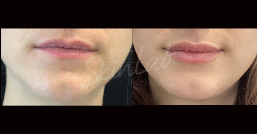 Skinlab Liquid Lip Lift Treatment