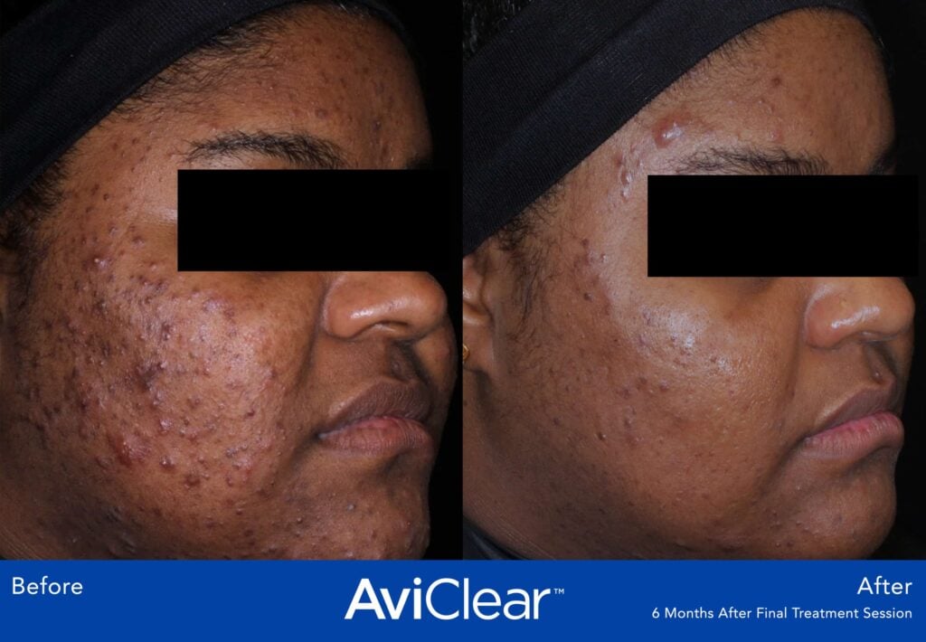SkinLab AviClear® Treatment