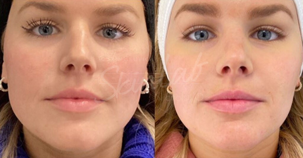 SkinLab Facial Slimming Treatment
