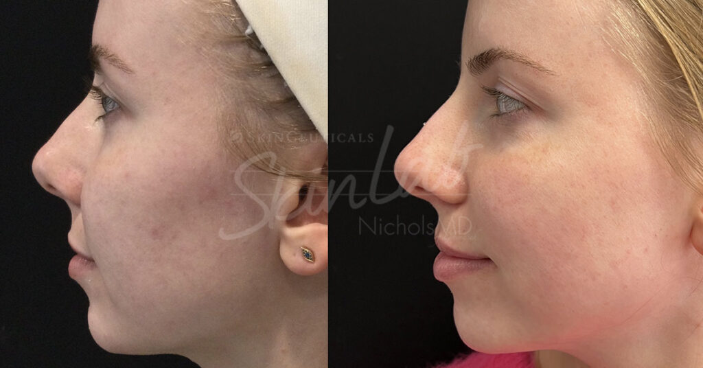 SkinLab AviClear Treatment