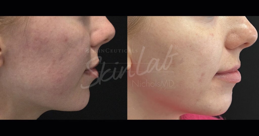 SkinLab AviClear Treatment