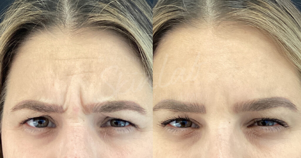 Botox for the Brow